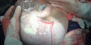 Bayi Ini Lahir Dalam Kondisi Terbungkus Gelembung Ketuban