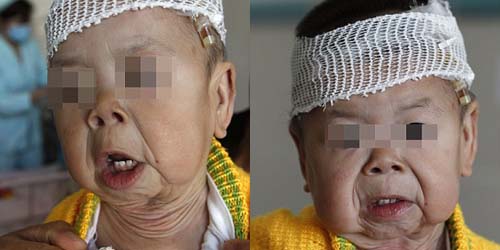 Terkena Penyakit Langka Yuxin Xiaoli Bayi 18 Bulan Memiliki Kulit Keriput