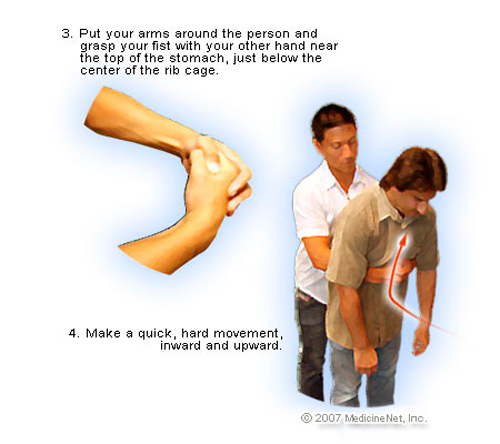 Memberikan pertolongan Heimlich maneuver @kaskus.co.id
