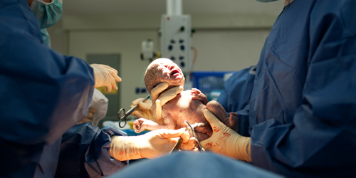 Bayi Kembar Tanpa Kepala Lahir di Zimbabwe, Langsung Mati