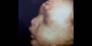 Foto USG 4 Dimensi Bayi Daus Mini