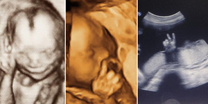 10 Foto USG Bayi dengan Pose Aneh