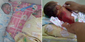 Bayi Kembar Siam Tewas Terpanggang di Inkubator RS Bunda Makassar