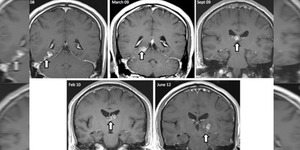 Dikira Migrain, Ternyata Cacing Pita Hidup Di Otak Pria Inggris