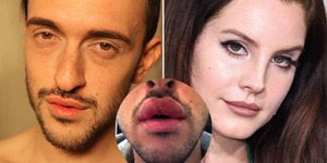 Pria Ini Gagal Operasi Bibir Mirip Lana Del Rey