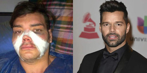 Fran Mariano Operasi Plastik 12 Kali Agar Mirip Ricky Martin