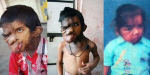 Miris, Bocah India Penderita Tumor Disebut Monster