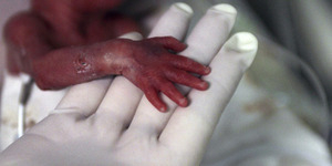 Bayi Lahir Prematur Kepalanya Putus Ditarik Dokter