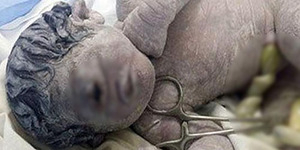 Bayi 'Cyclopia' Bermata Satu Tanpa Hidung Lahir di Mesir