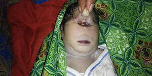 Heboh! Lahir Bayi Mata Satu di Papua