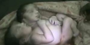 Bayi Berkepala Dua Lahir di India, Ibunda Syok