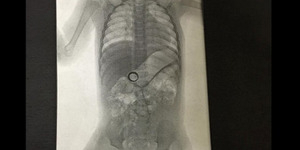 Foto Sinar X Perut Bayi 14 Bulan Terdapat Cincin Kawin Ibunya