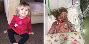 Ibu Sebar Foto Dampak Mengerikan Meningitis Pada Putrinya