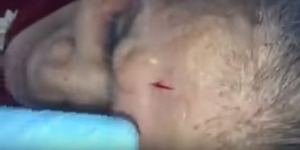 Video Ngeri Proses Pengeluaran Susuk di Wajah