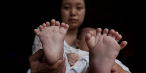 Bayi Abnormal di Tiongkok Punya 31 Jari, Turunan Ibunya